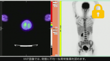 Case5 乳癌治療前の評価 スライド