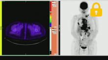 Case6  乳癌の転移診断 スライド