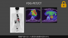 Case3 縦隔腫瘍