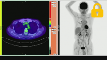 Case2 肺癌のリンパ節転移診断