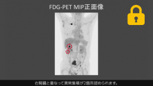 Case3  肺癌の質的画像診断