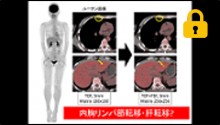 術後化学療法後 サムネイル