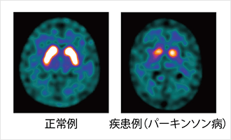 正常例 疾患例(パーキンソン病)