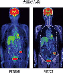 大腸がん例 PET画像 PET/CT