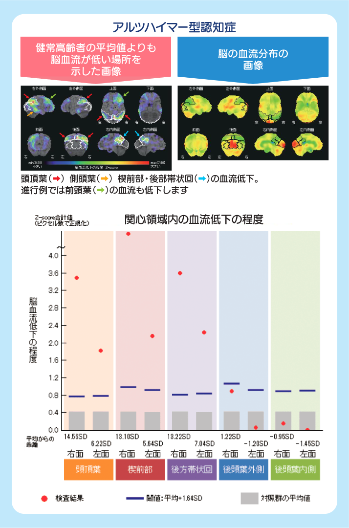 アルツハイマー型認知症　SPECT画像