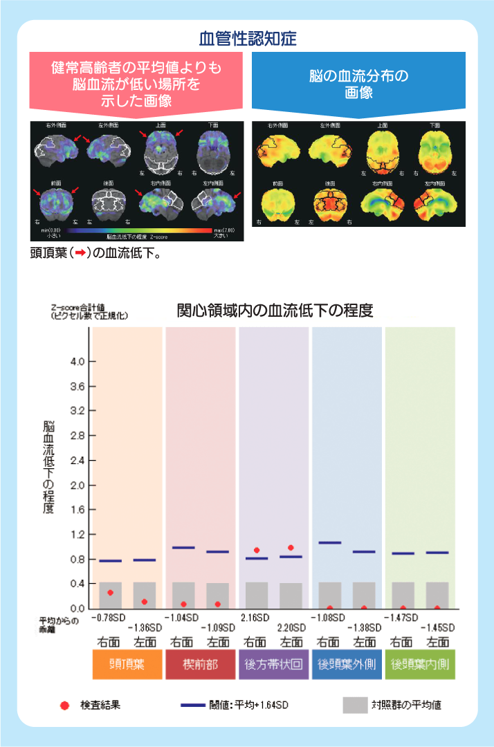 血管性認知症 SPECT画像