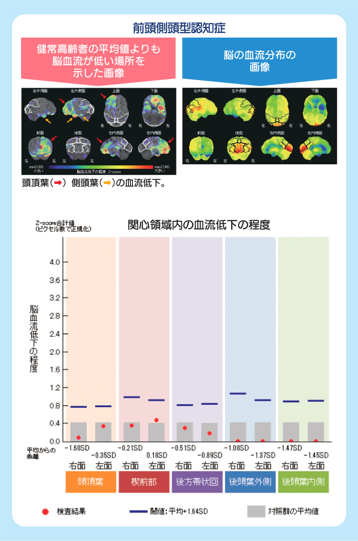 前頭側頭型認知症 SPECT画像